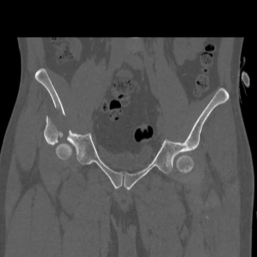 Acetabular and ilial fractures (Radiopaedia 59084-66378 Coronal bone window 19).jpg