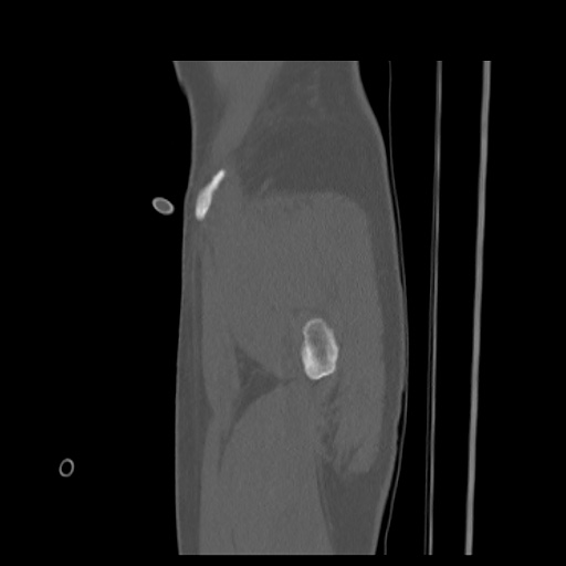 Acetabular and ilial fractures (Radiopaedia 59084-66378 Sagittal bone window 5).jpg