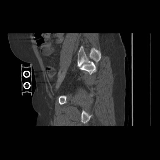 File:Acetabular fracture (Radiopaedia 13193-13212 Sagittal bone window 31).jpg