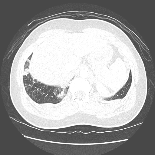 File:Achalasia (Radiopaedia 52507-58417 Axial lung window 58).jpg