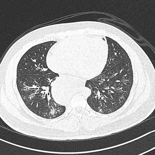 File:Achalasia with aspiration (Radiopaedia 55413-61845 Axial lung window 48).jpg