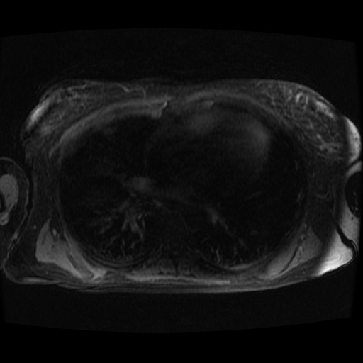 Acinar cell carcinoma of the pancreas (Radiopaedia 75442-86668 Axial late phase (~30 mins) 153).jpg