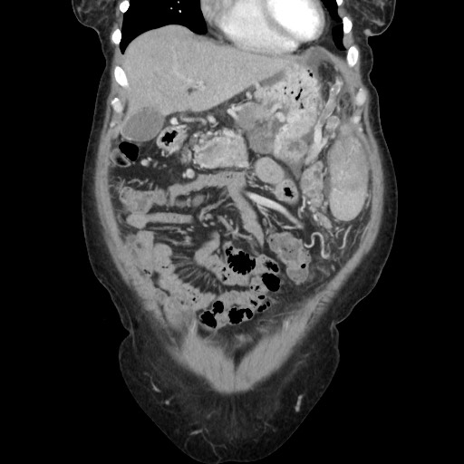 Acinar cell carcinoma of the pancreas (Radiopaedia 75442-86669 Coronal C+ portal venous phase 34).jpg