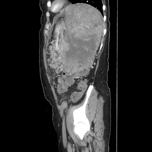 Acinar cell carcinoma of the pancreas (Radiopaedia 75442-86669 Sagittal C+ portal venous phase 148).jpg