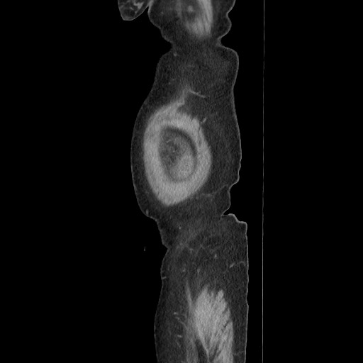 File:Acinar cell carcinoma of the pancreas (Radiopaedia 75442-86669 Sagittal C+ portal venous phase 24).jpg