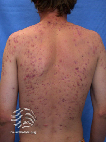File:Acne affecting the back images (DermNet NZ acne-acne-back-188).jpg