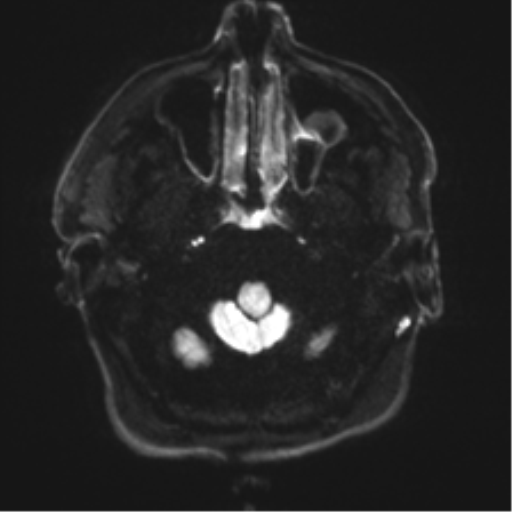 File:Acoustic schwannoma (Radiopaedia 50846-56358 Axial DWI 29).png