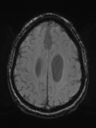 Acoustic schwannoma (Radiopaedia 55729-62281 Axial SWI 39).png