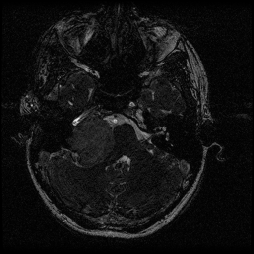 Acoustic schwannoma - eroding petrous apex (Radiopaedia 39674-42004 Axial T2 28).png