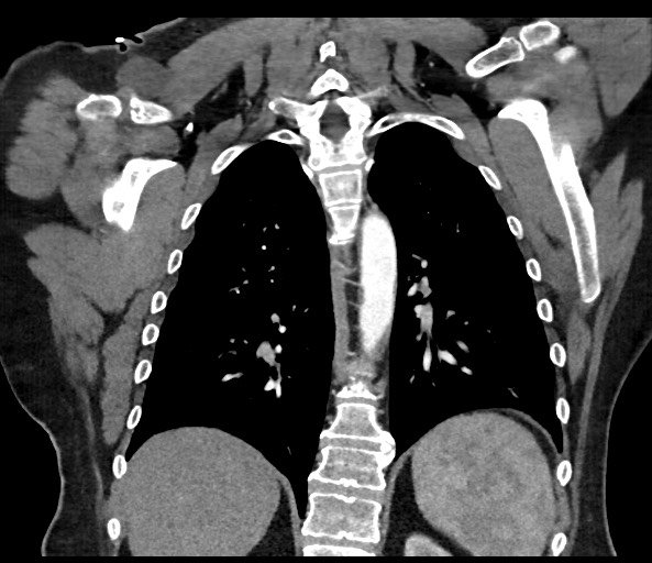 Acromioclavicular joint cyst (Radiopaedia 58455-65610 Coronal C+ arterial phase 100).jpg