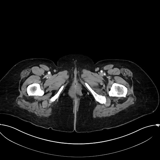 File:Active Crohn disease (Radiopaedia 59394-66750 Axial C+ portal venous phase 77).jpg