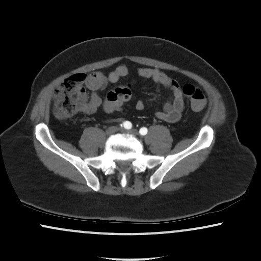 Active colonic bleed on CT (Radiopaedia 49765-55025 Axial C+ arterial phase 57).jpg