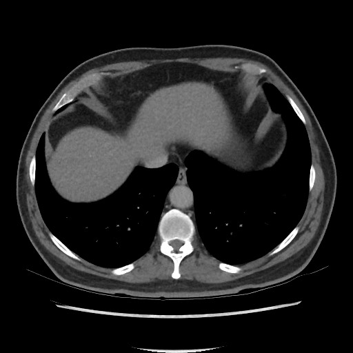 File:Active colonic bleed on CT (Radiopaedia 49765-55025 Axial C+ delayed 10).jpg