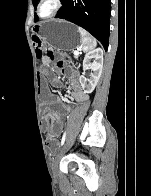 Active crohn disease (Radiopaedia 87133-103397 Sagittal C+ arterial phase 64).jpg
