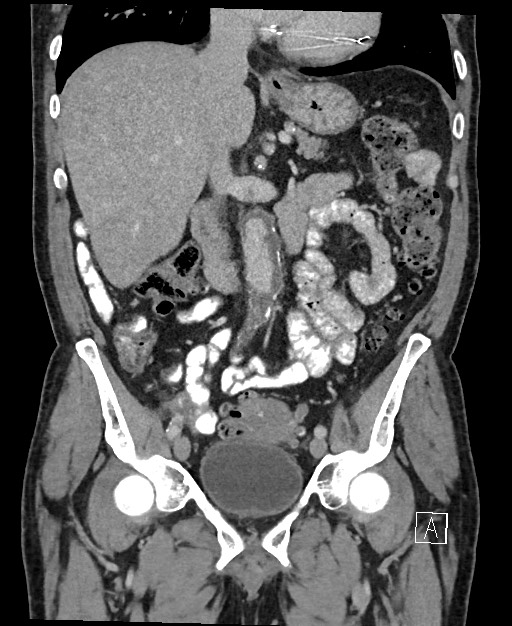 Active lower gastrointestinal bleeding - diverticular (Radiopaedia 61203-69106 Coronal C+ portal venous phase 66).jpg