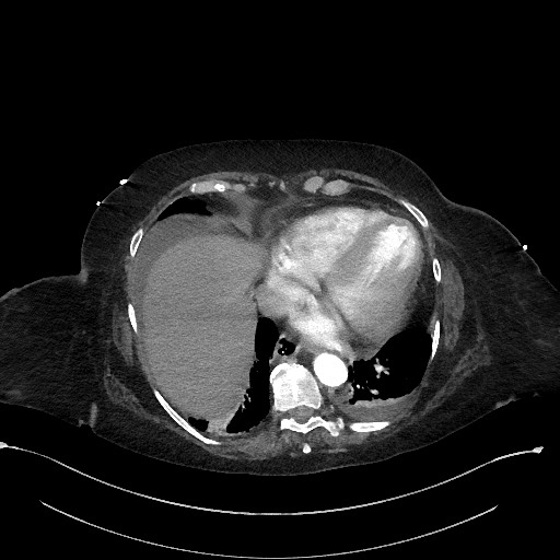 Active renal extravasation with large subcapsular and retroperitoneal hemorrhage (Radiopaedia 60975-68796 Axial C+ arterial phase 23).jpg