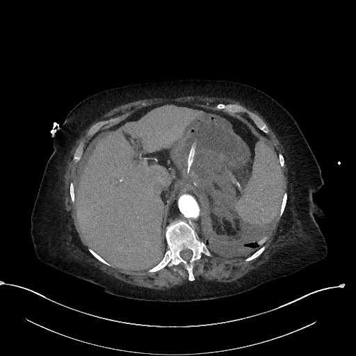 Active renal extravasation with large subcapsular and retroperitoneal hemorrhage (Radiopaedia 60975-68796 Axial C+ arterial phase 43).jpg