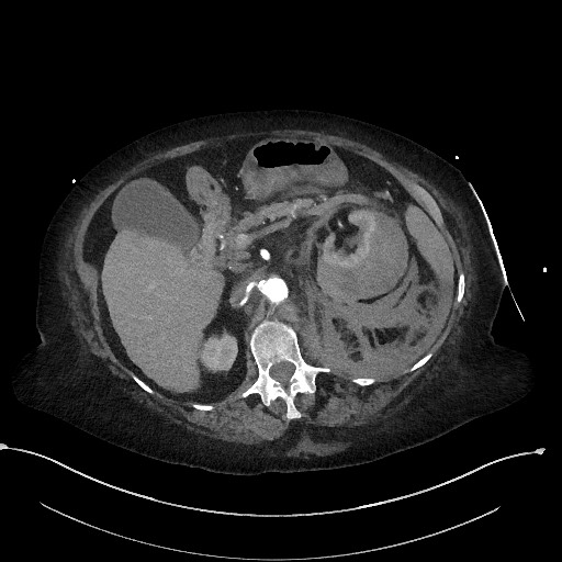 Active renal extravasation with large subcapsular and retroperitoneal hemorrhage (Radiopaedia 60975-68796 Axial C+ arterial phase 69).jpg