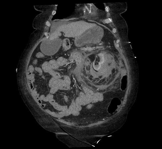 Active renal extravasation with large subcapsular and retroperitoneal hemorrhage (Radiopaedia 60975-68796 Coronal C+ arterial phase 46).jpg