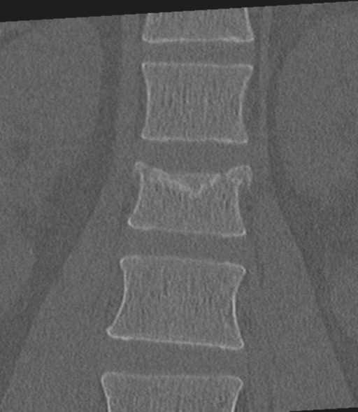 Acute L1 burst compression fracture (Radiopaedia 34430-35755 Coronal bone window 20).png