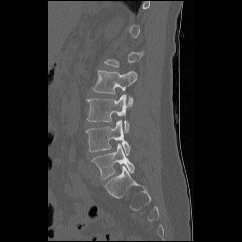 Acute Schmorl's node (Radiopaedia 83276-102365 Sagittal bone window 30).jpg