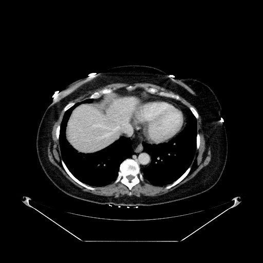 Acute appendicitis, heterotaxy syndrome (Radiopaedia 66884-76202 Axial C+ portal venous phase 15).jpg