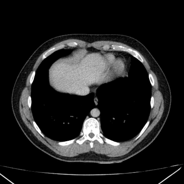 File:Acute appendicitis (Radiopaedia 38255-40270 Axial C+ portal venous phase 5).jpg