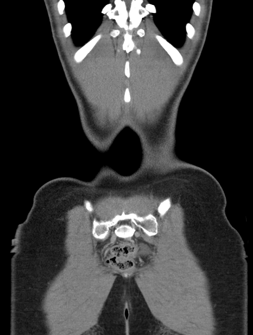 Acute appendicitis (Radiopaedia 62608-70901 Coronal C+ portal venous phase 58).jpg
