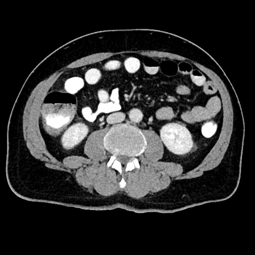 Acute appendicitis (Radiopaedia 77016-88960 Axial C+ portal venous phase 75).jpg