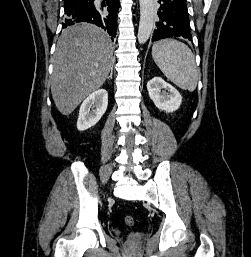 File:Acute appendicitis (Radiopaedia 79950-93224 Coronal C+ portal venous phase 66).jpg