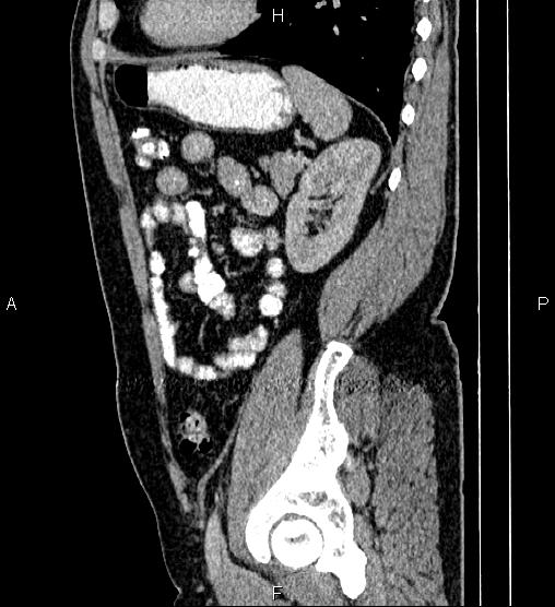 Acute appendicitis (Radiopaedia 84780-100240 Sagittal C+ portal venous phase 77).jpg