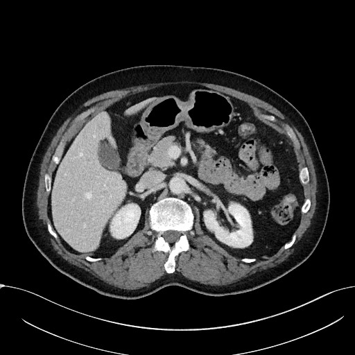 File:Acute appendicitis - large appendicoliths (Radiopaedia 61805-69820 Axial C+ portal venous phase 43).jpg