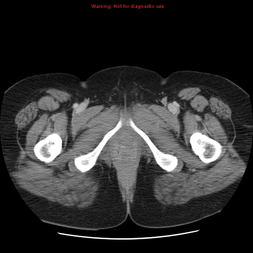 Acute appendicitis complicated by ovarian vein thrombophlebitis (Radiopaedia 16172-15851 Axial C+ portal venous phase 92).jpg