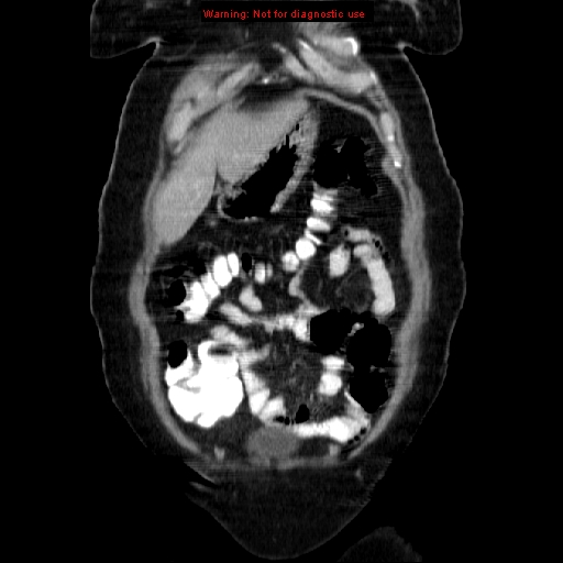 Acute appendicitis complicated by ovarian vein thrombophlebitis (Radiopaedia 16172-15851 Coronal C+ portal venous phase 19).jpg