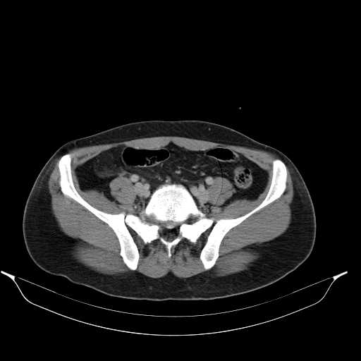 File:Acute appendicitis with appendicoliths (Radiopaedia 21148-21062 Axial C+ portal venous phase 14).jpg