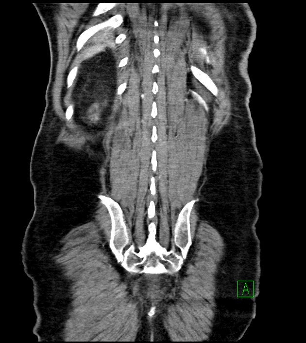 Acute arterial mesenteric ischemia (Radiopaedia 78238-90828 Coronal C+ portal venous phase 78).jpg
