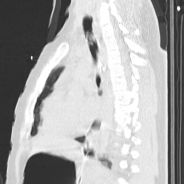 Acute aspiration pneumonitis (Radiopaedia 33605-34703 Sagittal lung window 48).jpg
