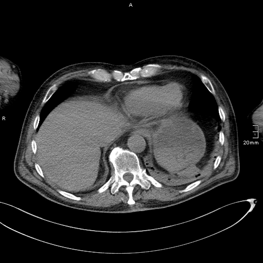 Acute aspiration pneumonitis (Radiopaedia 55642-62166 Axial liver window 52).jpg