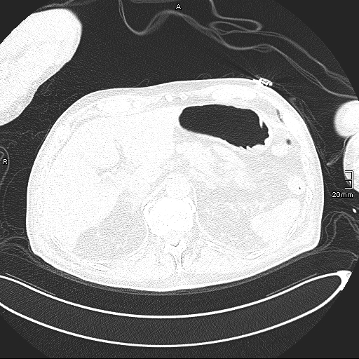 Acute aspiration pneumonitis (Radiopaedia 55642-62166 Axial lung window 151).jpg