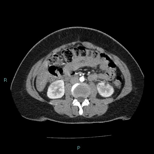 Acute bilateral pyelonephritis (Radiopaedia 37146-38881 Axial C+ arterial phase 99).jpg