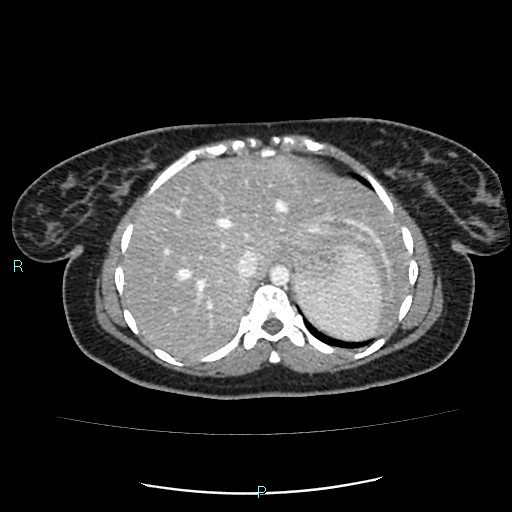 Acute bilateral pyelonephritis (Radiopaedia 37146-38881 Axial C+ portal venous phase 14).jpg