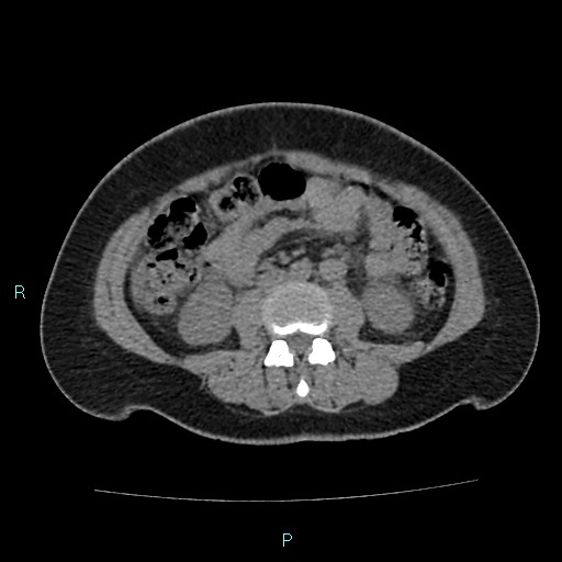 Acute bilateral pyelonephritis (Radiopaedia 37146-38881 Axial non-contrast 56).jpg