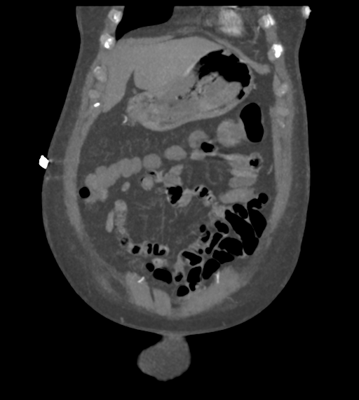 File:Acute bleed from gastric fundus biopsy site (Radiopaedia 35201-36737 Coronal C+ arterial phase 14).png