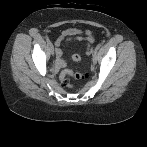 File:Acute cholecystitis and ureteric colic (Radiopaedia 42330-45444 Axial prone 93).jpg