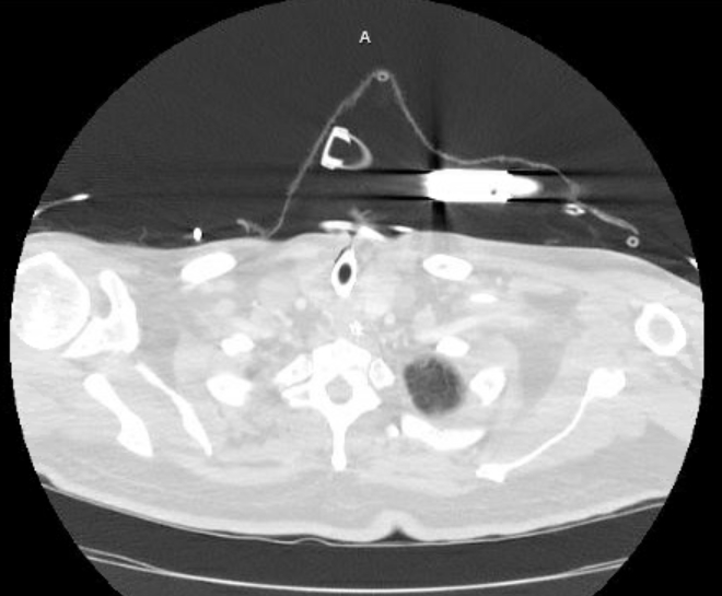 Acute cor pulmonale (ultrasound) (Radiopaedia 83508-98818 Axial lung window 3).jpg