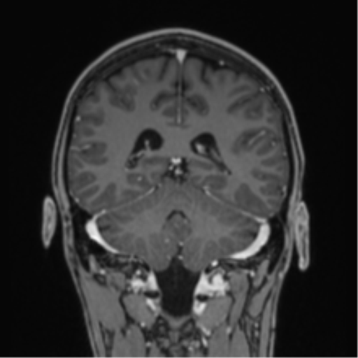 Acute disseminated encephalomyelitis (ADEM) (Radiopaedia 65319-74349 Coronal T1 C+ 10).png