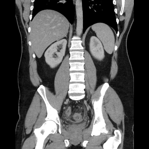 Acute diverticulitis with localized perforation (Radiopaedia 41296-44113 Coronal C+ portal venous phase 41).jpg