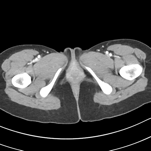 Acute gangrenous appendicitis with perforation (Radiopaedia 40152-42662 Axial C+ portal venous phase 82).png