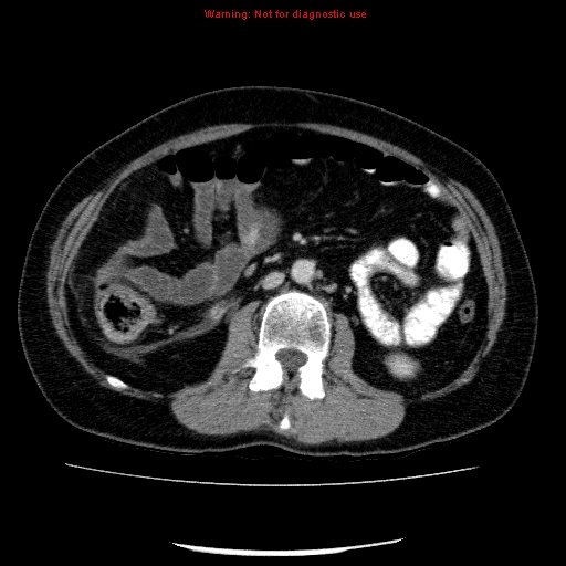 Acute gangrenous cholecystitis (Radiopaedia 10123-10661 Axial C+ portal venous phase 51).jpg