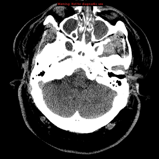 Acute hemorrhagic leukoencephalitis (Radiopaedia 14076-43697 Axial non-contrast 8).jpg